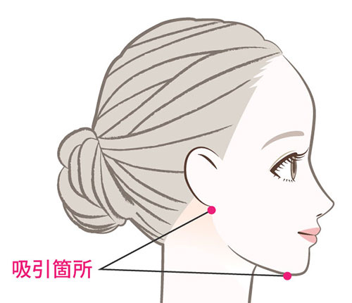 顔の脂肪吸引