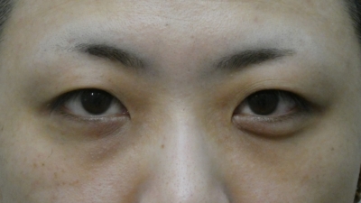 目頭切開・術前