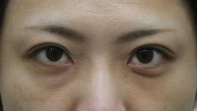 目頭切開・術後3ヶ月