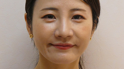 若返り・しわ・たるみ・1か月後