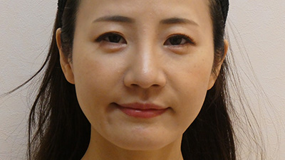 若返り・しわ・たるみ・手術前