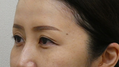 たるみ・フェイスリフト・手術前