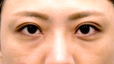 二重・まぶた整形・術後1か月