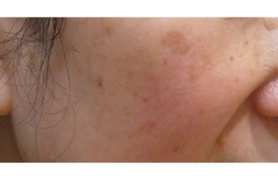 しみ・そばかす・術前