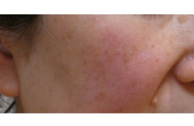 しみ・そばかす・術後