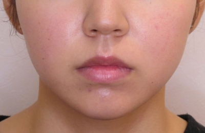 小顔整形・輪郭整形・術後６ヶ月正面