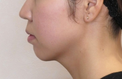 小顔整形・輪郭整形・術後6ヶ月横顔