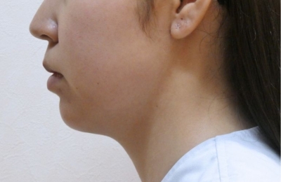 小顔整形・輪郭整形・術前横