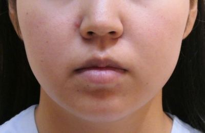 小顔整形・輪郭整形・術前正面